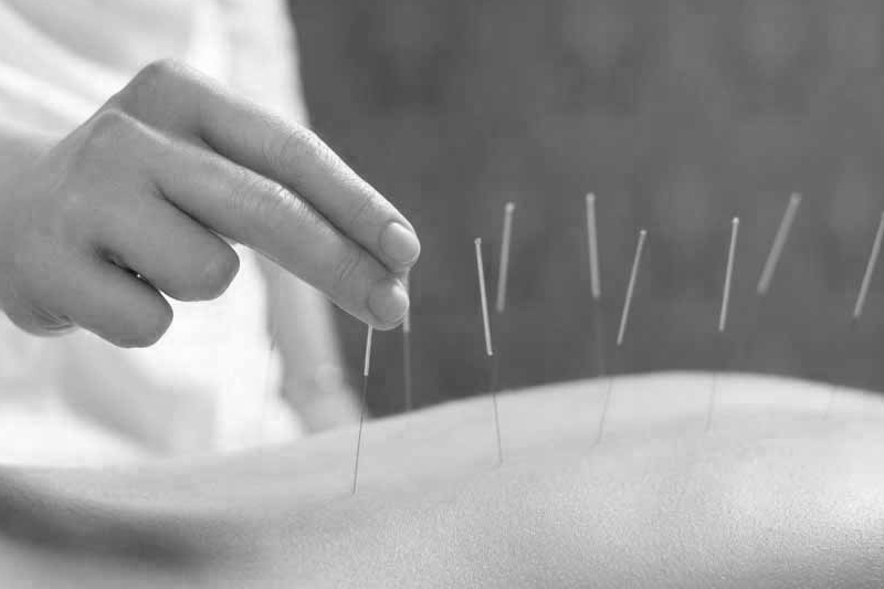 Acupuncture and SN