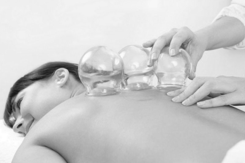  CUPPING